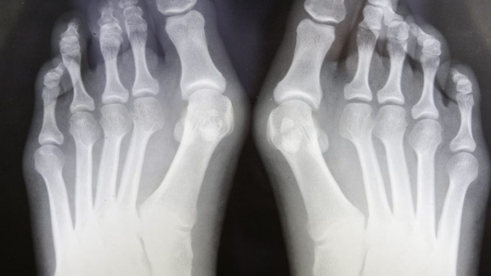 Tipos de cirugía del pie para tratamiento de juanetes