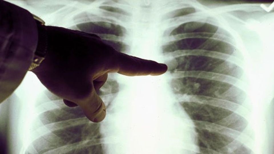 Síntomas del Cán bộ quản lý de pulmón